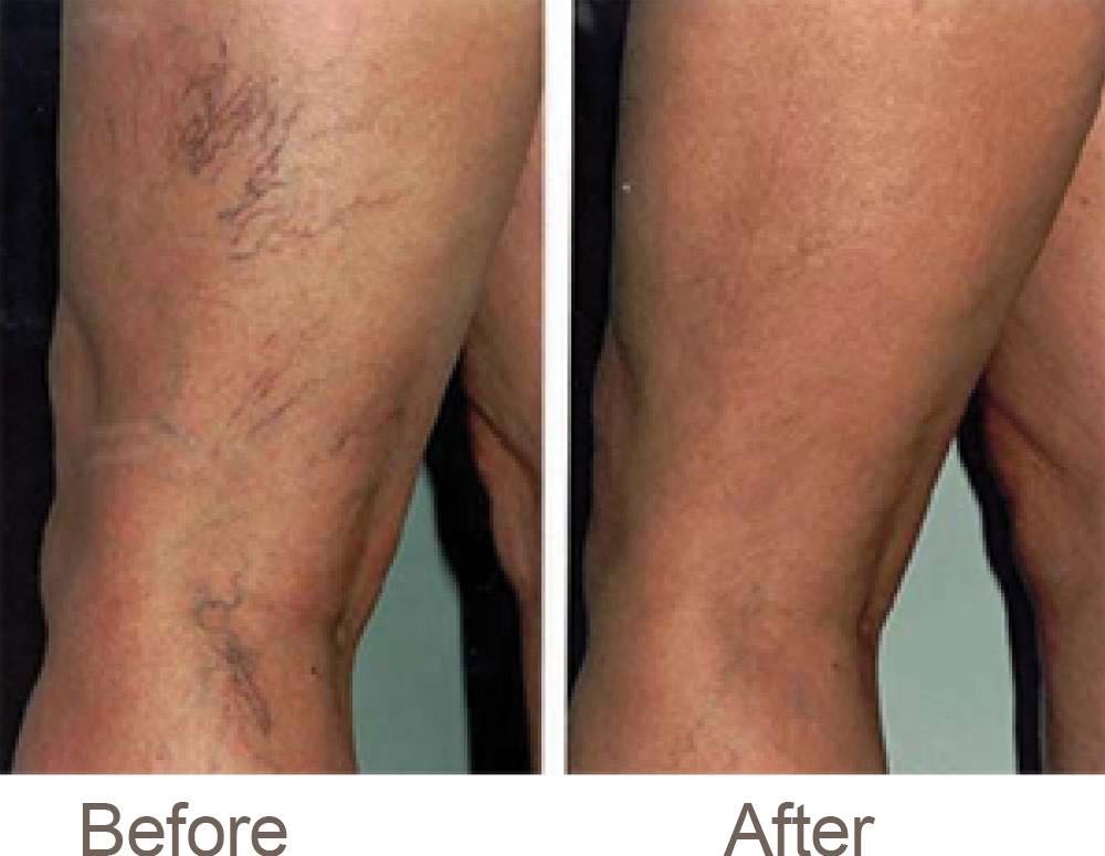 Before and after Sclerotherapy